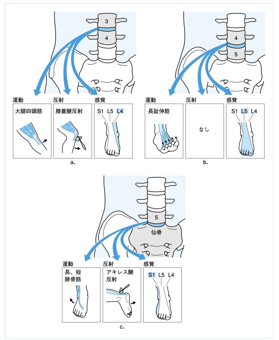 椎間板ヘルニア神経根領域
