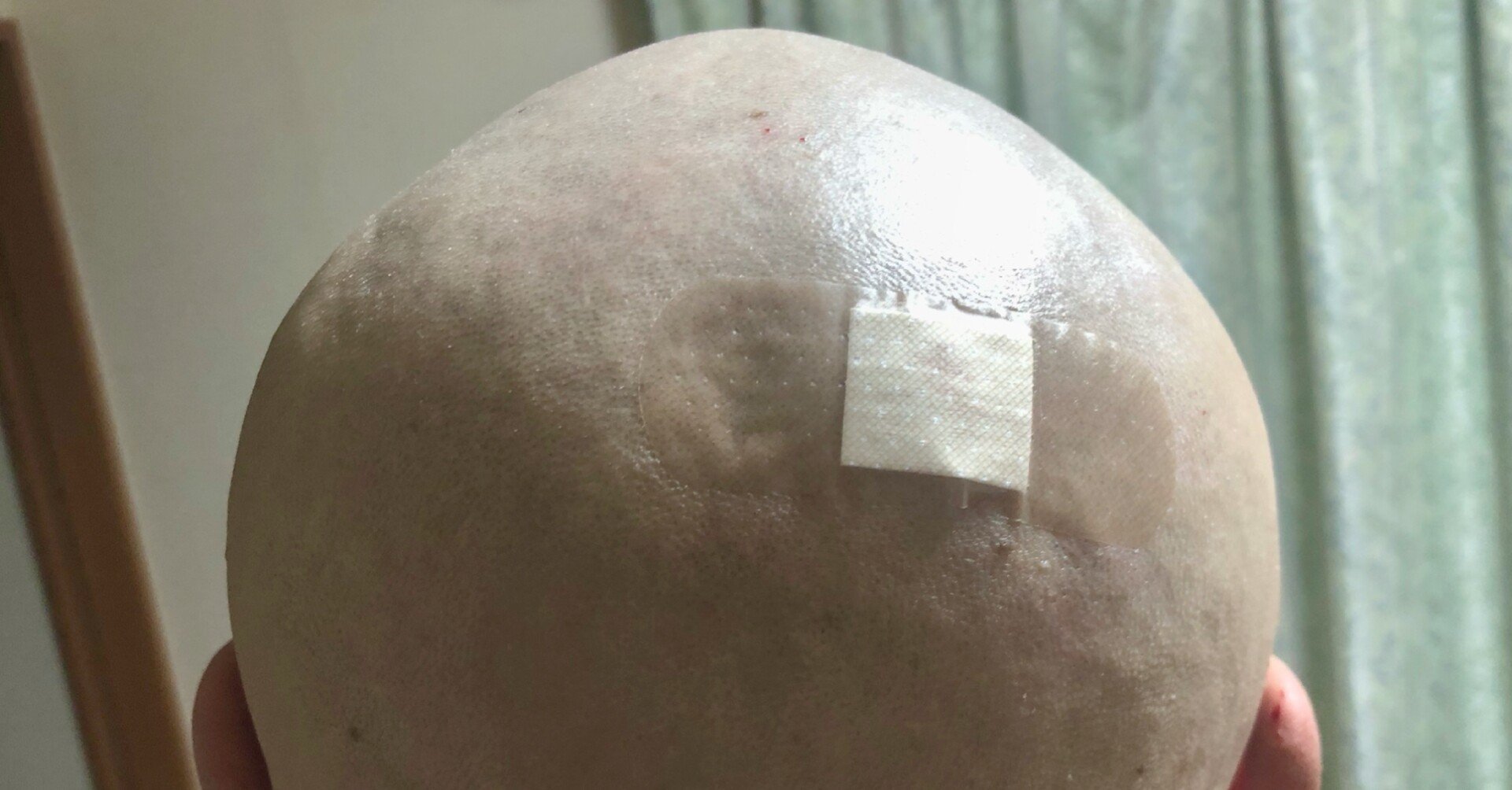 悩みこそさらけ出せ スキンヘッドにすれば全ては丸く収まる 高橋 優介 越後妻有の料理人タカハシ Note