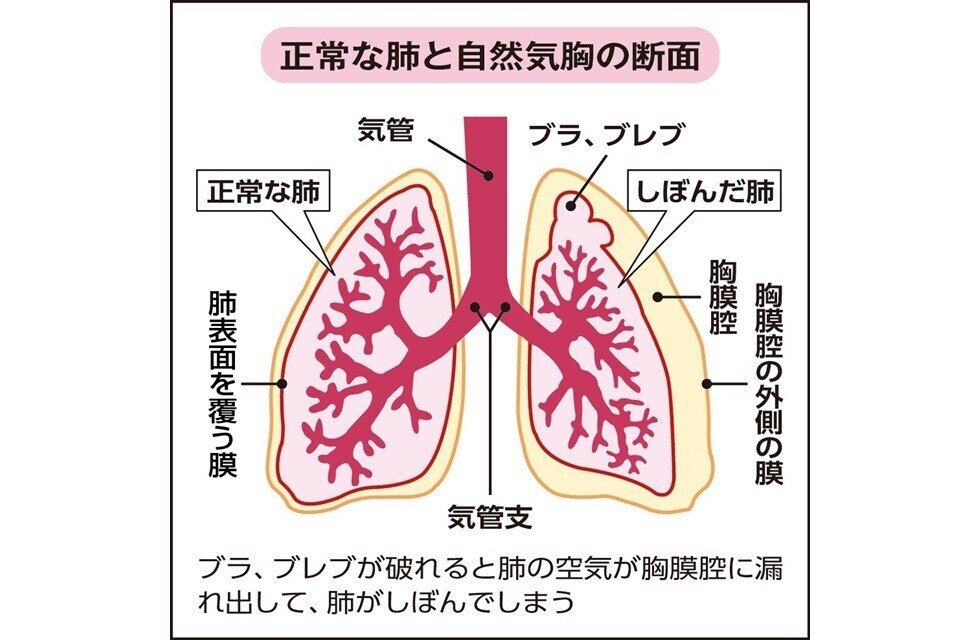 世の中には２種類の人間がいる 肺にドレーン管を入れたことがあるかないか その２種類だ Maki1810 Note