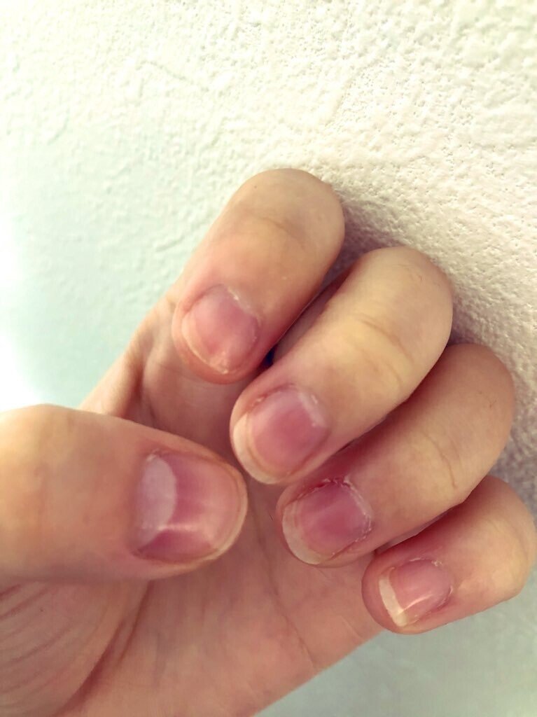 深爪だった私が半年で人前に出しても恥ずかしくない爪になった話 いずみ Note 深爪だった私が半年で人前に出しても恥ずかしくない爪になった話 いずみ Note