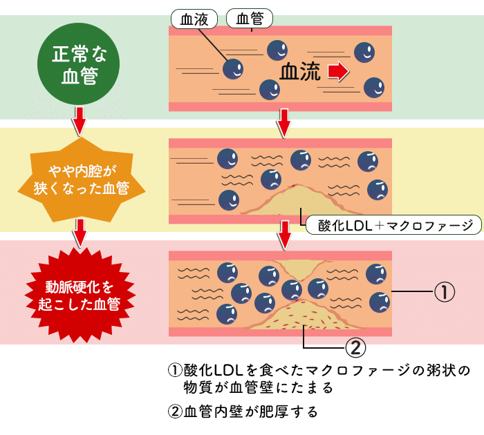 動脈硬化(テキスト枠外)