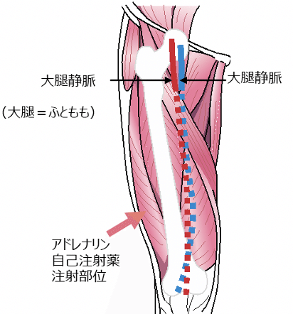 エピペン注射直前に確認すべき５つのこと Dr モッシー Note