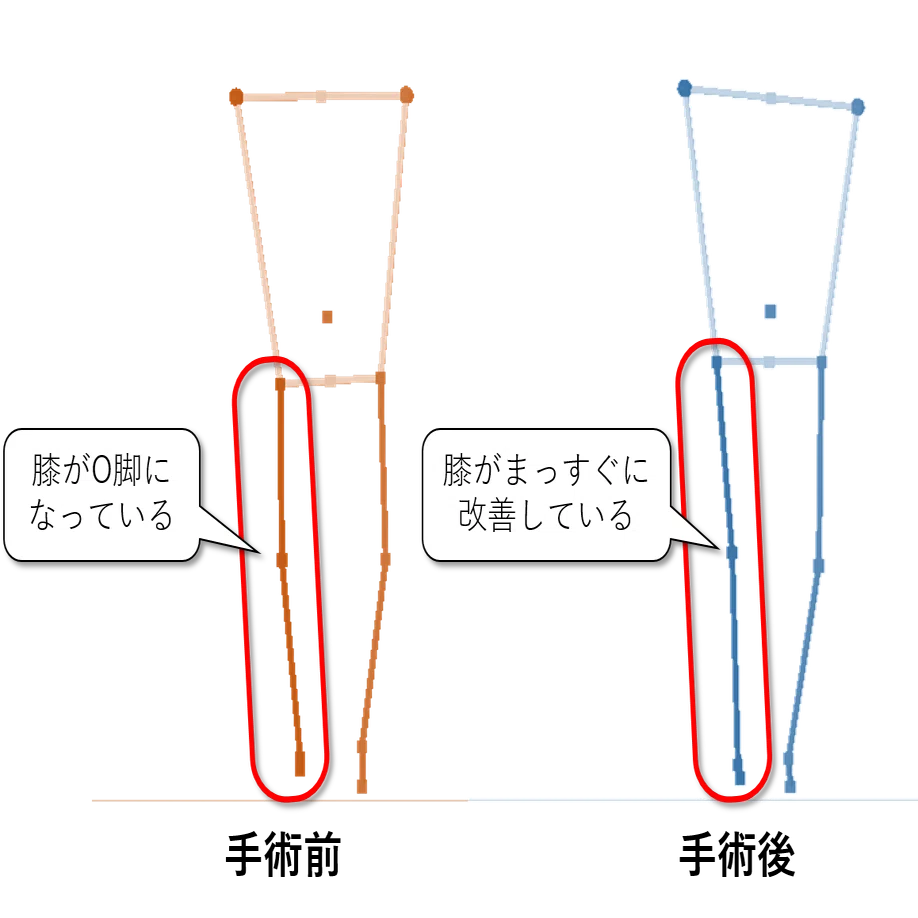 変形性膝関節症の歩行を手術前後で比較してみた｜キッセイコムテック