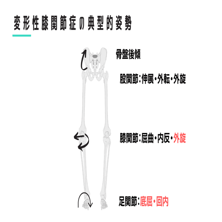 股関節からみた変形性膝関節症｜武田 純一