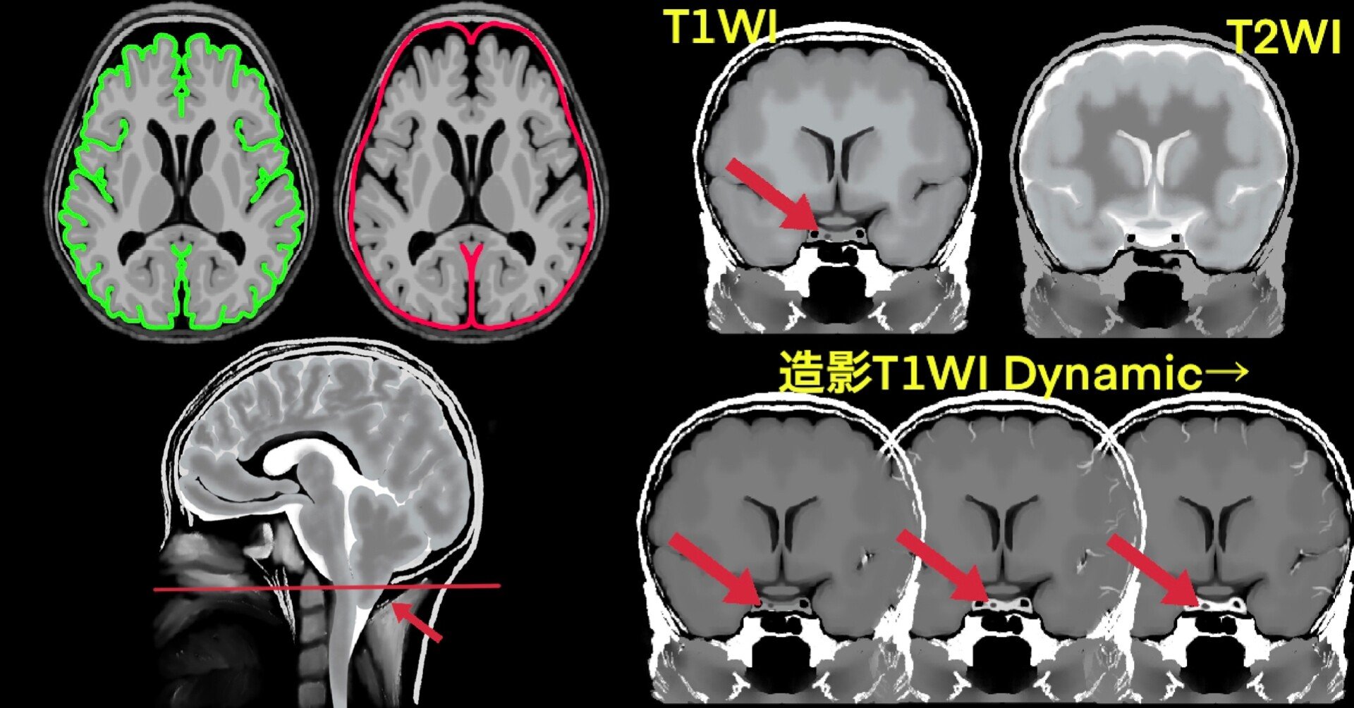 脳MRI 3 血管障害・腫瘍・感染症・他 脳MRI 3.血管障害・腫瘍・感染症
