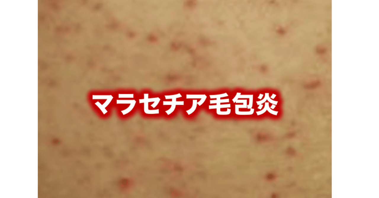マラセチア毛包炎 片柳ちひろ ニキビ博士 Note