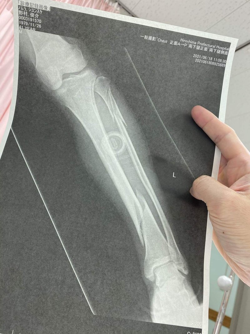 41歳2箇所骨折したおっさんの今 野村 俊介 Note