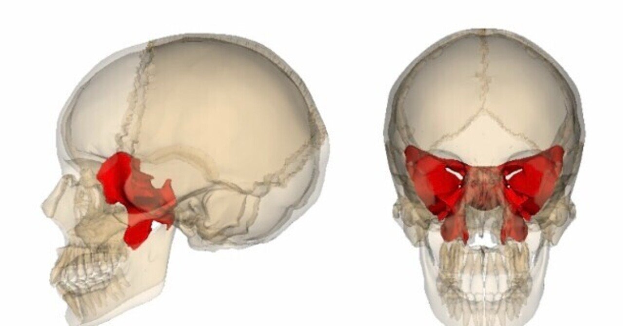側頭骨蝶形骨と無血手術と17症候群 側頭骨蝶形骨と無血手術と17症候群
