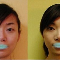 面長の原因 ボトックス ヒアルロン顔 お顔の整体師 戸塚哲春 Note 面長の原因 ボトックス ヒアルロン顔 お顔の整体師 戸塚哲春 Note