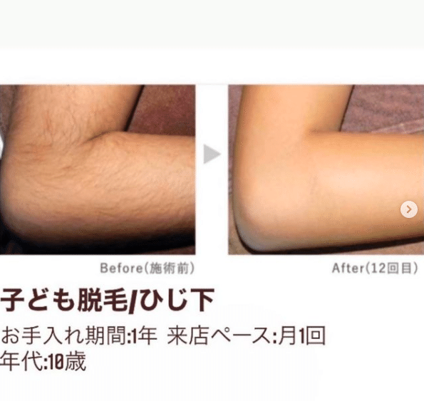 福山市で脱毛サロンをお探しの方 みち Note