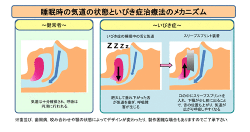 体験談 いびき治療 手術で喉激痛 睡眠薬との関係 もぶめろちゃん Note