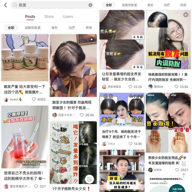 中国2 5億人がハゲに悩む 若者も投資する抜け毛ヘアケア 植毛市場の今 China Cosmetic Lab Note