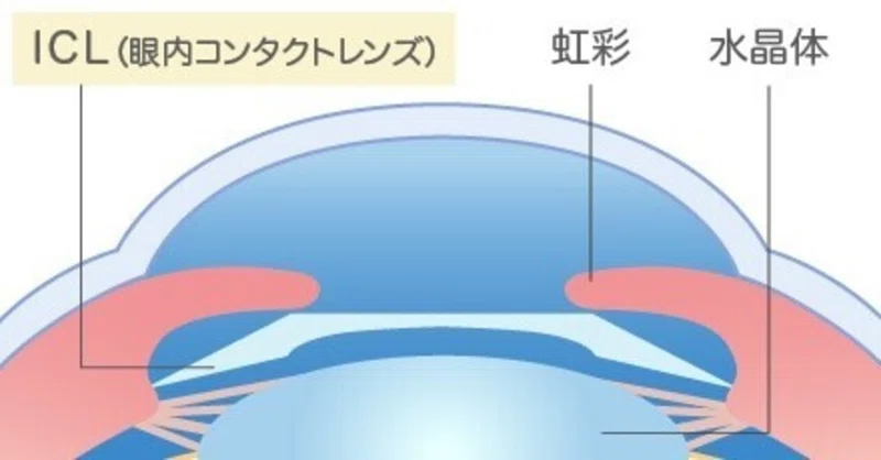 Icl 眼内コンタクトレンズ 治療をして2年半 メリット デメリット Hide Shikama フォロバ100 Note