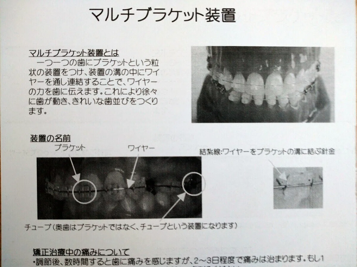 T歯科矯正マルチブラケット
