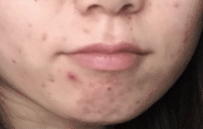 ニキビとの戦い 図工 Note