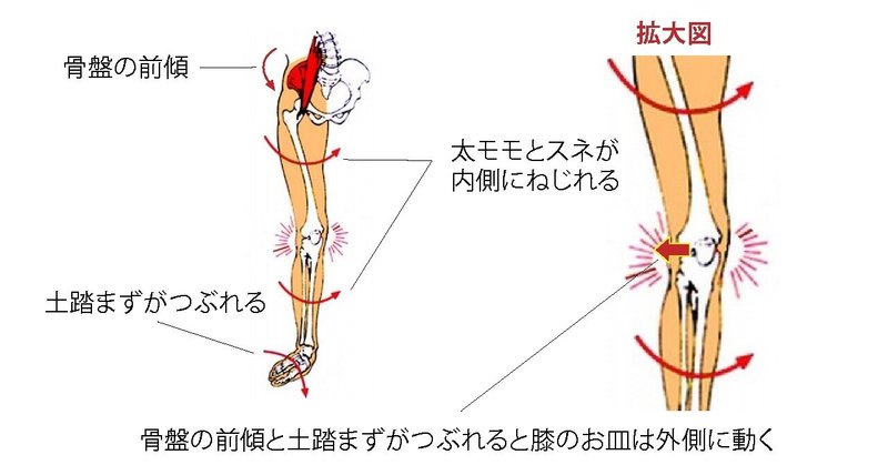 膝蓋骨の外方偏移