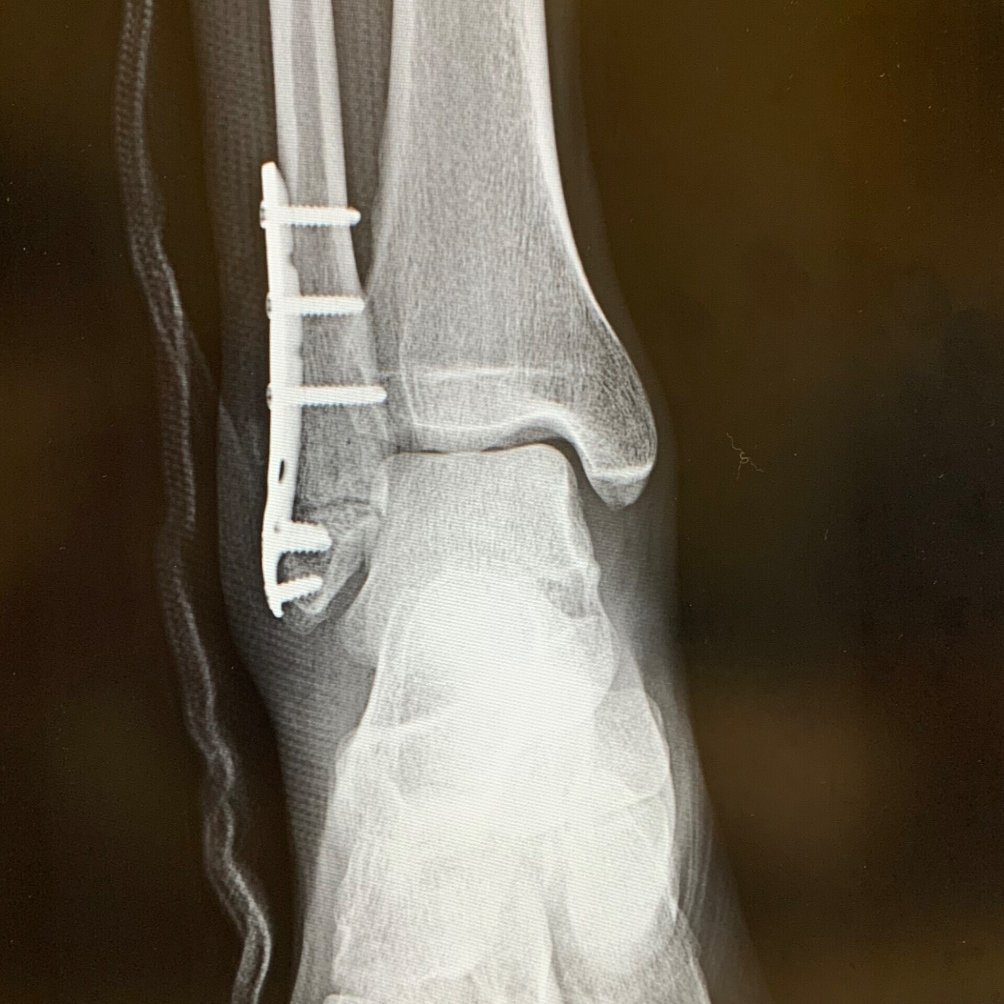 右足首骨折 外果骨折 その 整骨院受診 松葉杖きつい Fukuda Note