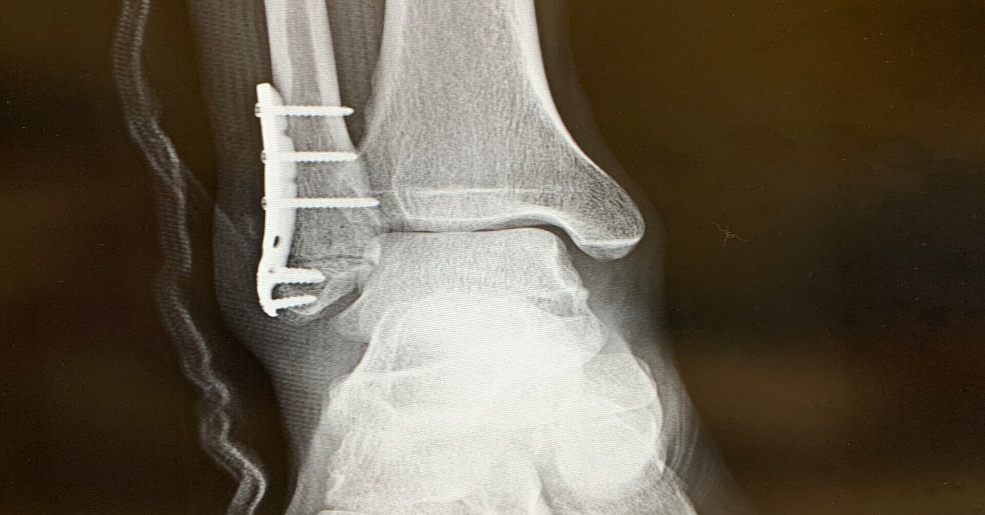 右足首骨折 外果骨折 その 整骨院受診 松葉杖きつい Fukuda Note 右足首骨折 外果骨折 その 整骨院受診 松葉杖きつい Fukuda Note