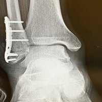 右足首骨折 外果骨折 その 整骨院受診 松葉杖きつい Fukuda Note