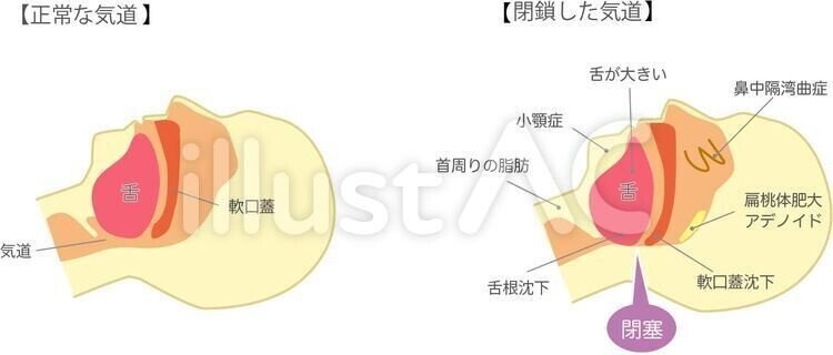 New Style イラストフリー素材 無呼吸症候群 図解 無料 イラスト無料提供中 一部有料 Note