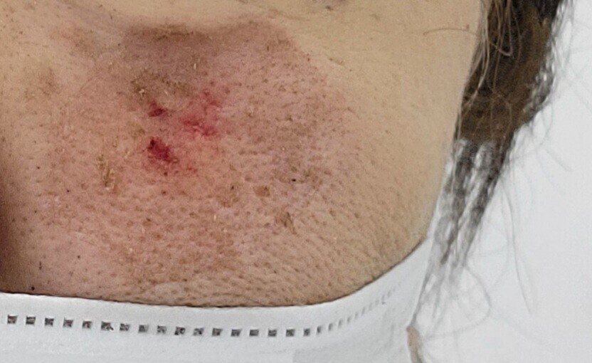 炭酸レーザー治療をしました 一週間 谷本惠美 エッセイスト 心理職 Note