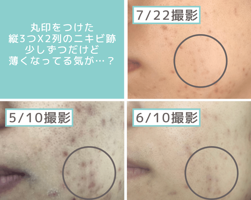 混合肌にも Twitterで話題のベビーオイル洗顔 Miiko Bihadapj Note 混合肌にも Twitterで話題のベビーオイル洗顔 Miiko Bihadapj Note
