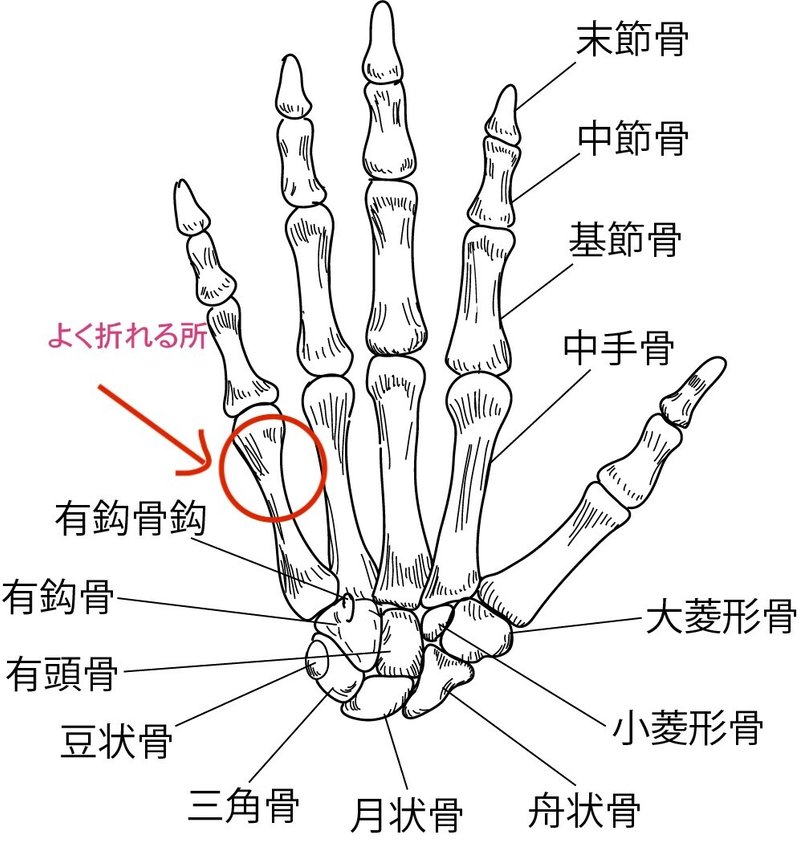 手骨折　ボクサー骨折　解剖　骨