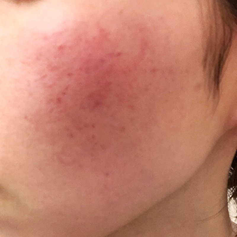 酒さ様皮膚炎の治療方法 分かりやすく解説します K Tomo Chiroru Note