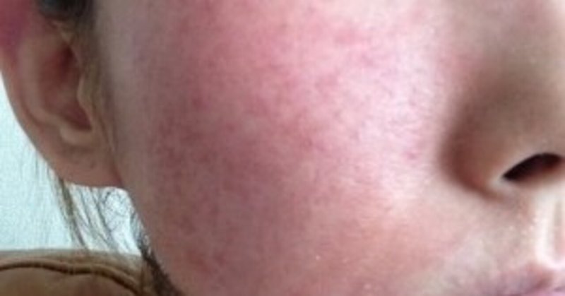 赤ら顔 の新着タグ記事一覧 Note つくる つながる とどける