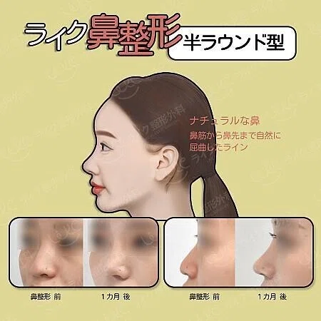 鼻の整形手術 カウンセリング編 やさぐれ Note