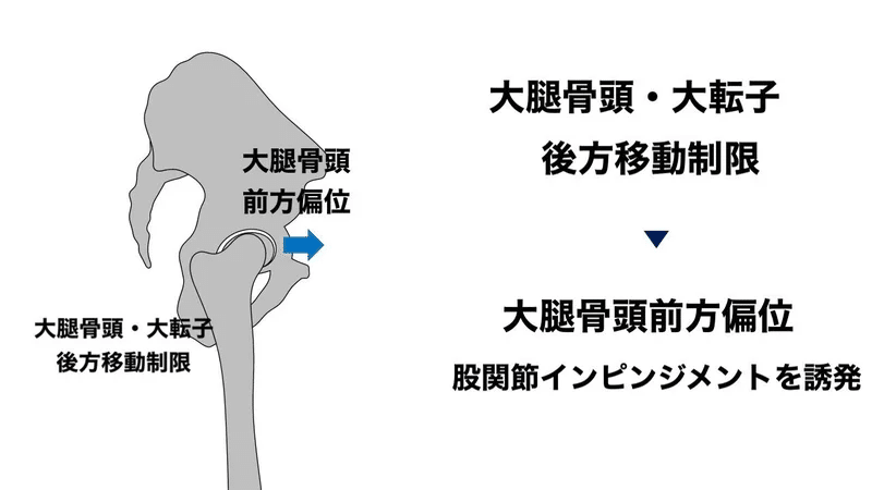 股関節インピンジメントに対するアプローチ L Fit Note