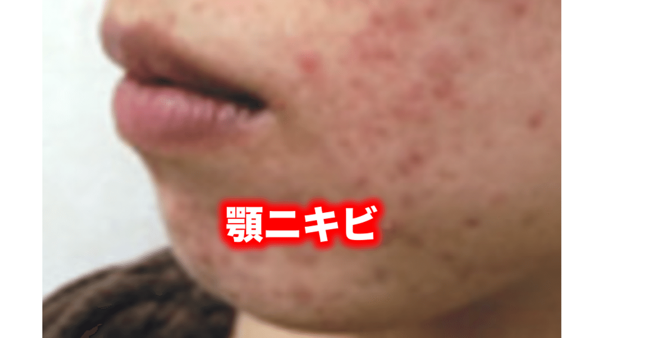 顎のニキビ 片柳ちひろ ニキビ博士 Note