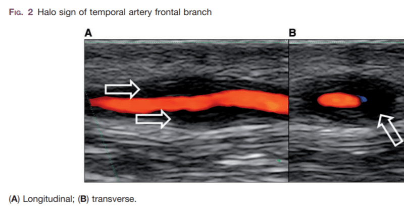 プレドニンはどのような副作用を引き起こす可能性がありますか?