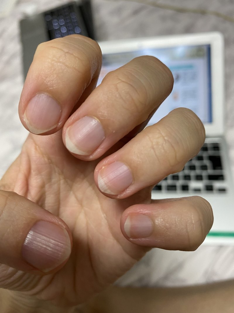 爪の育成 ハイポニキウムは全然生えてこない 痛風雑技団 団長 Note 爪の育成 ハイポニキウムは全然生えてこない 痛風雑技団 団長 Note