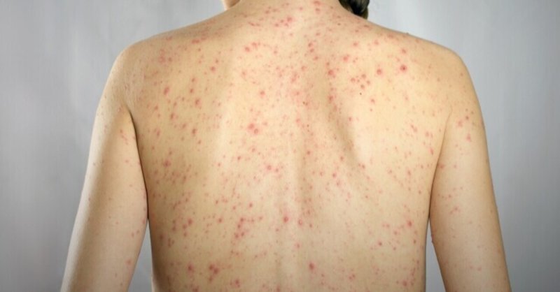 アレルギー改善への道〜②0歳から13歳までのアレルギーの経緯（Vo.３）