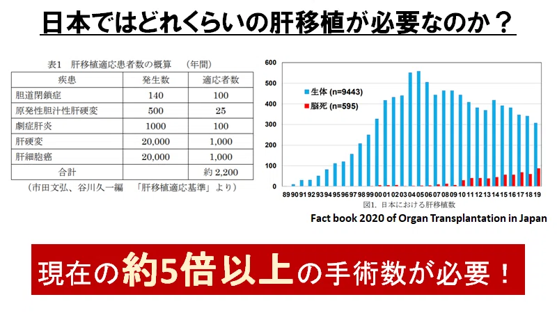 日本の臓器移植治療に未来はあるのか？世界の最先端と比較し正直に考察