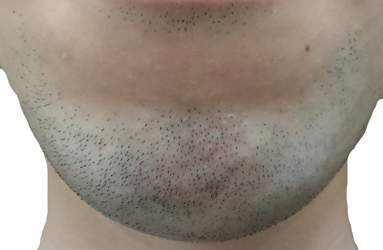 顎脱毛開始前２４時間後