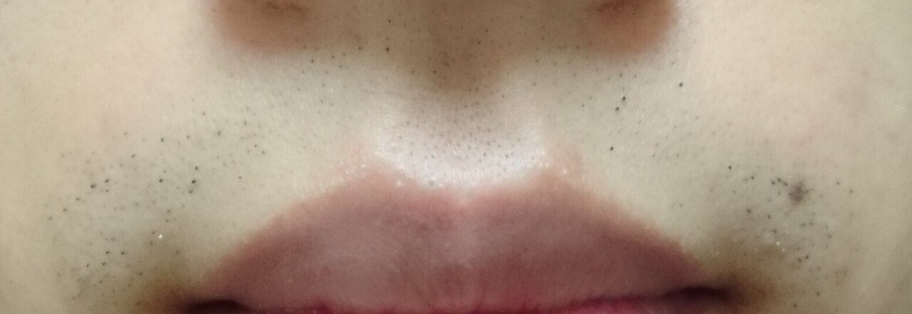 鼻下脱毛１回目２４時間後
