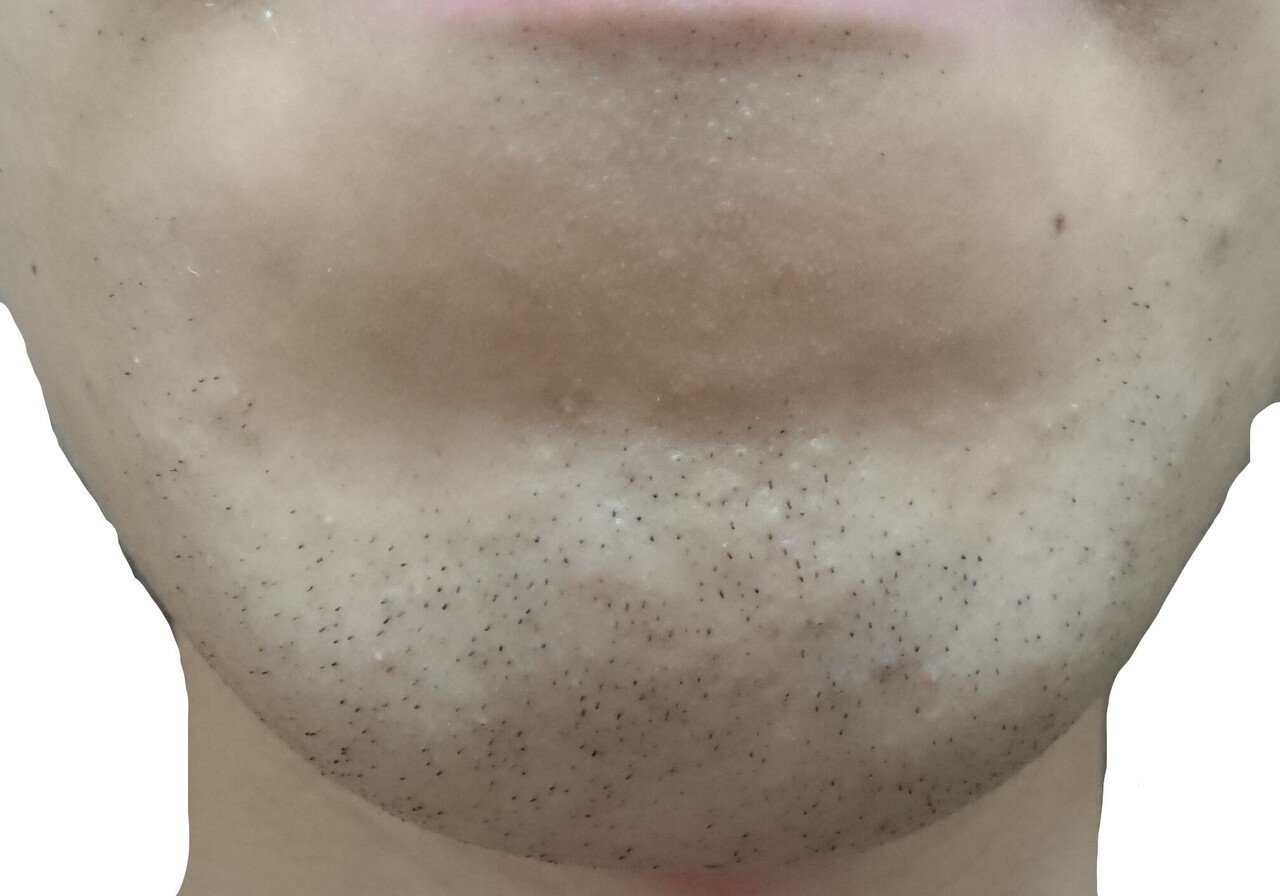 顎脱毛１回目２４時間後