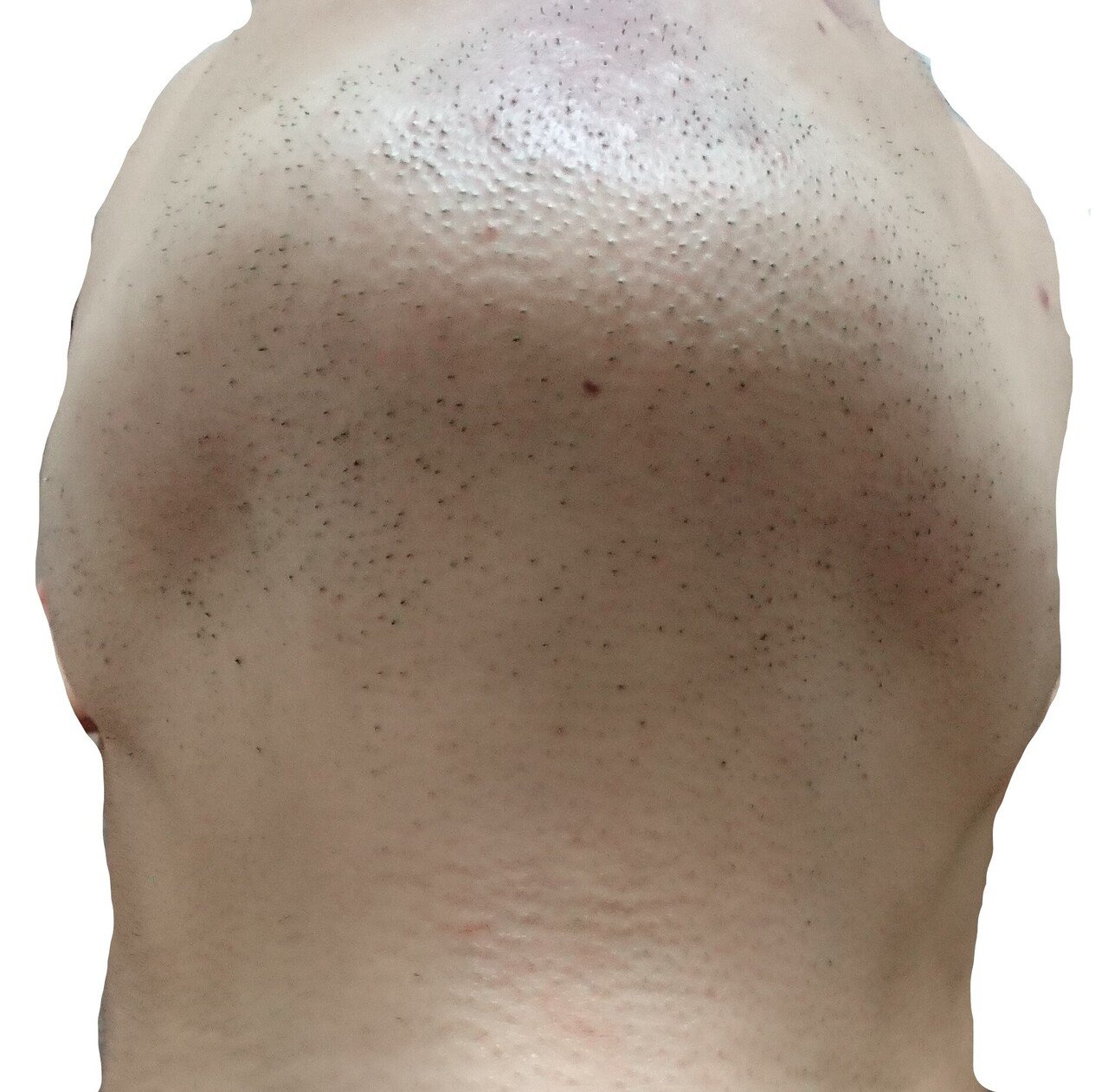 顎下脱毛１回目２４時間後