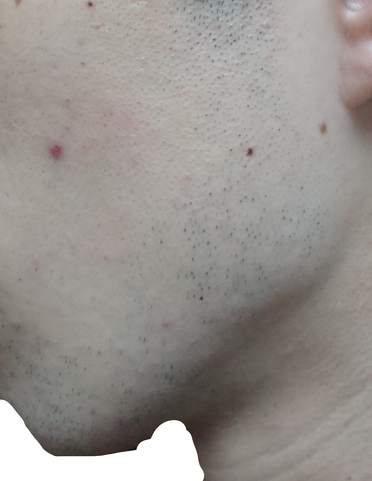 左もみあげ 脱毛１回目２４時間後