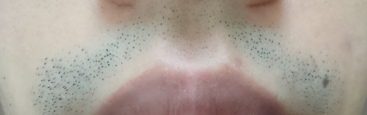 鼻下脱毛開始前２４時間後