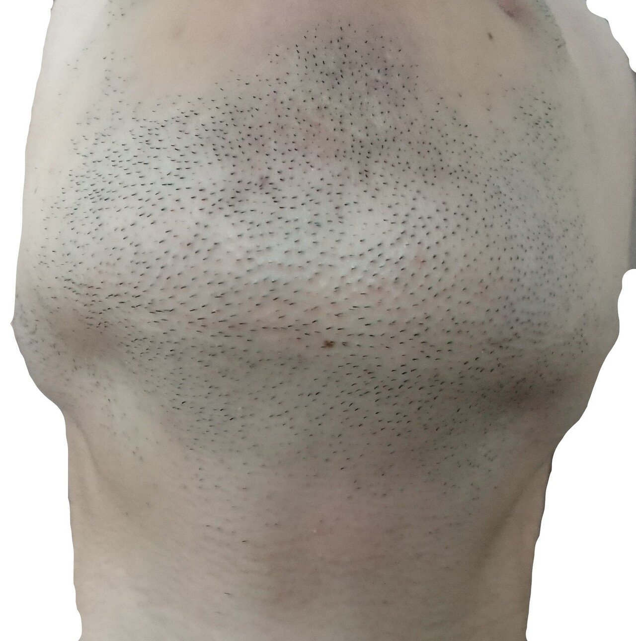 顎下脱毛開始前２４時間後