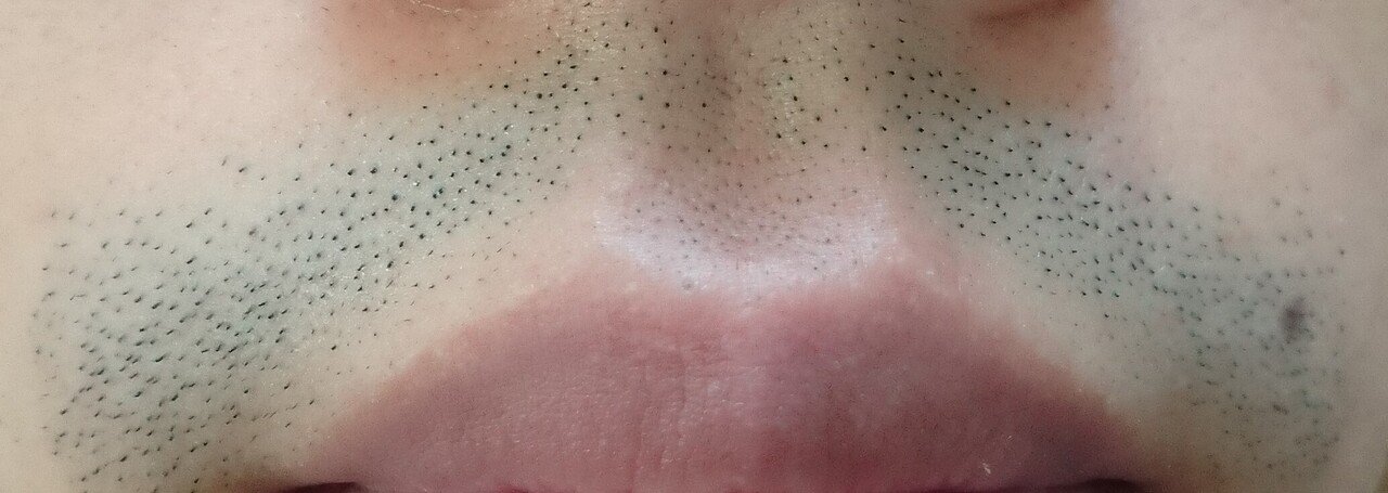 鼻下脱毛2回目直前24時間後