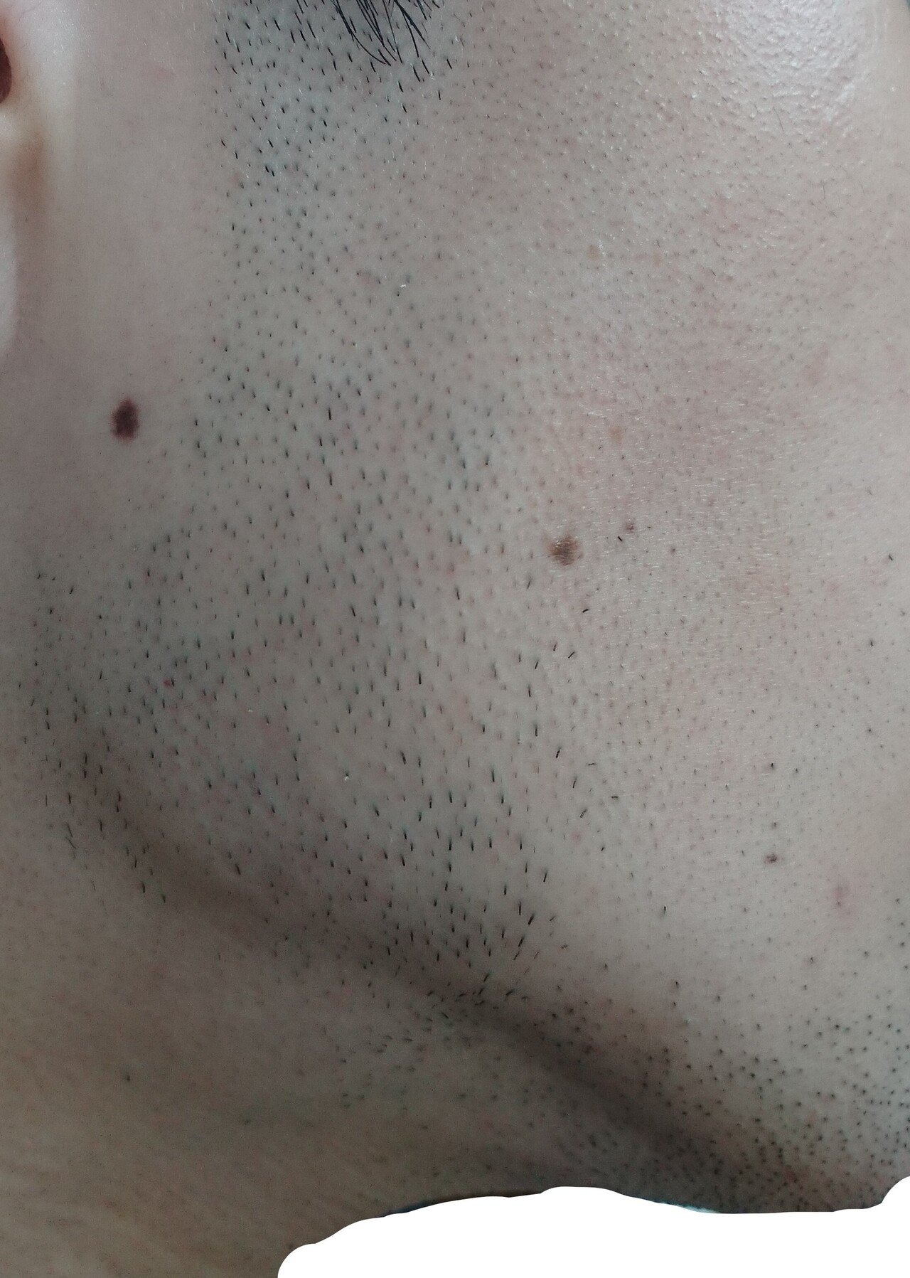 右もみあげ脱毛開始前２４時間後