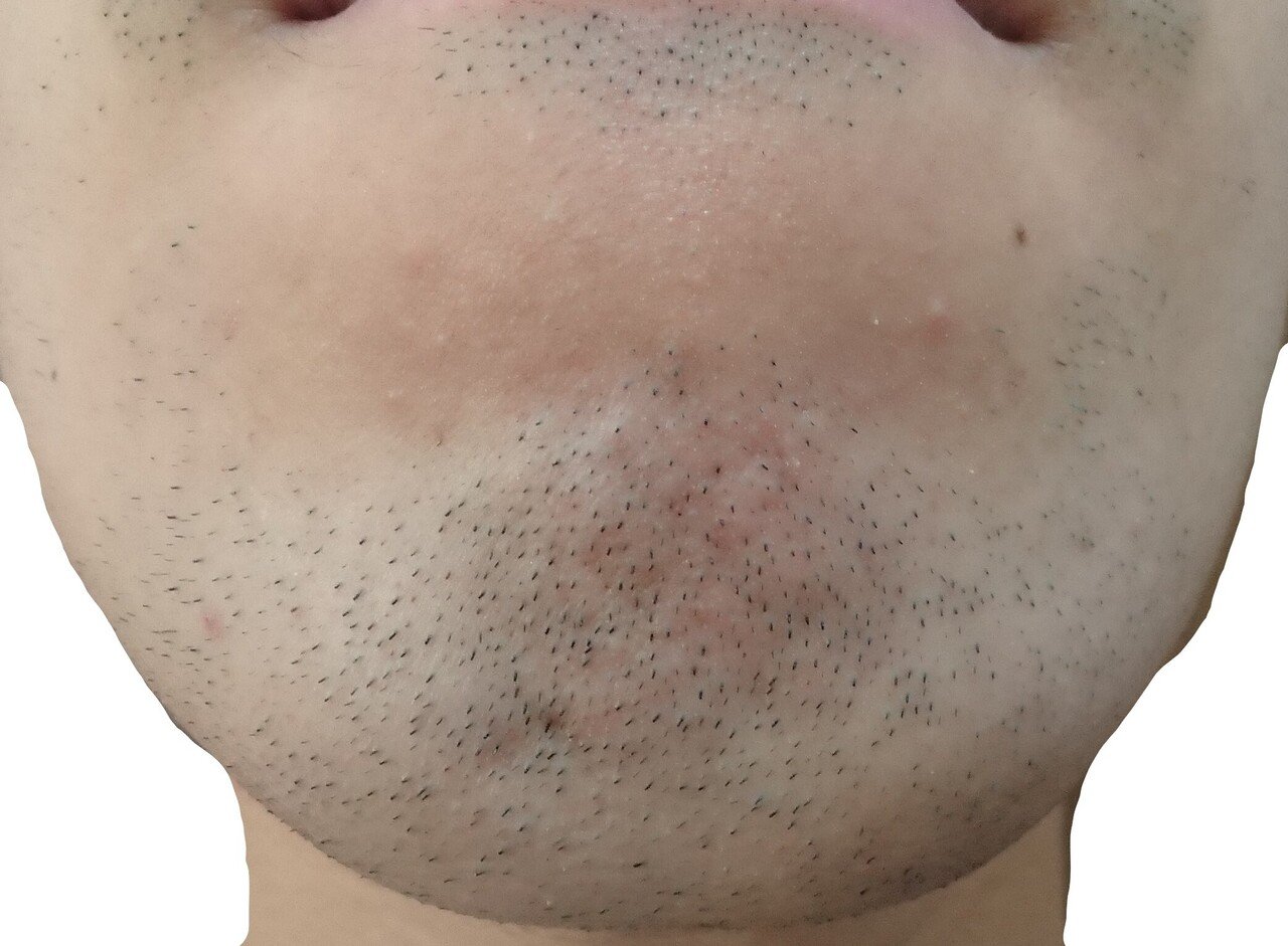 顎脱毛２回目直前２４時間後