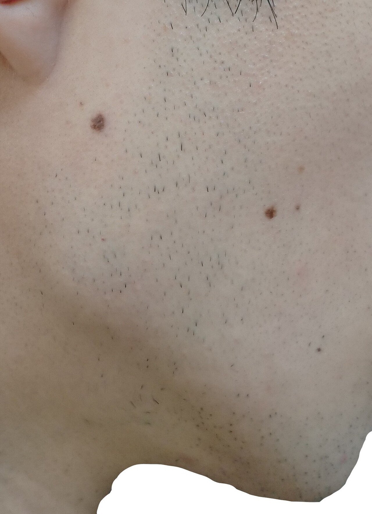 右もみあげ 脱毛2回目直前24時間後