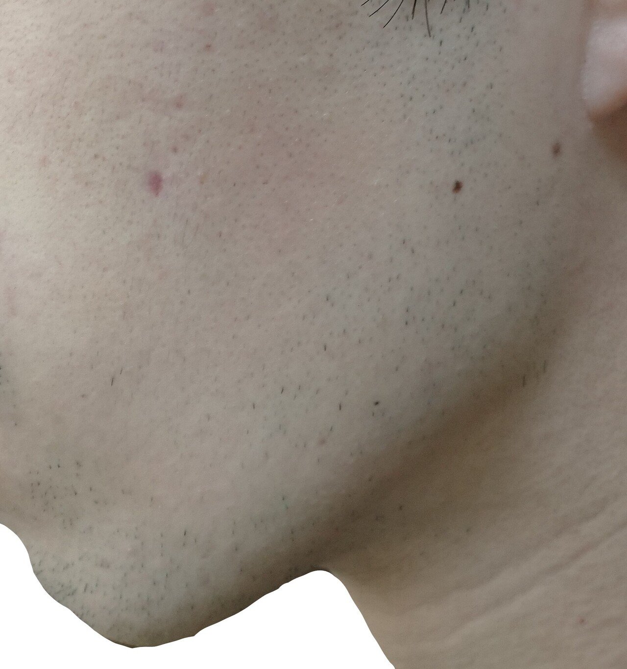 左もみあげ 脱毛2回目直前24時間後