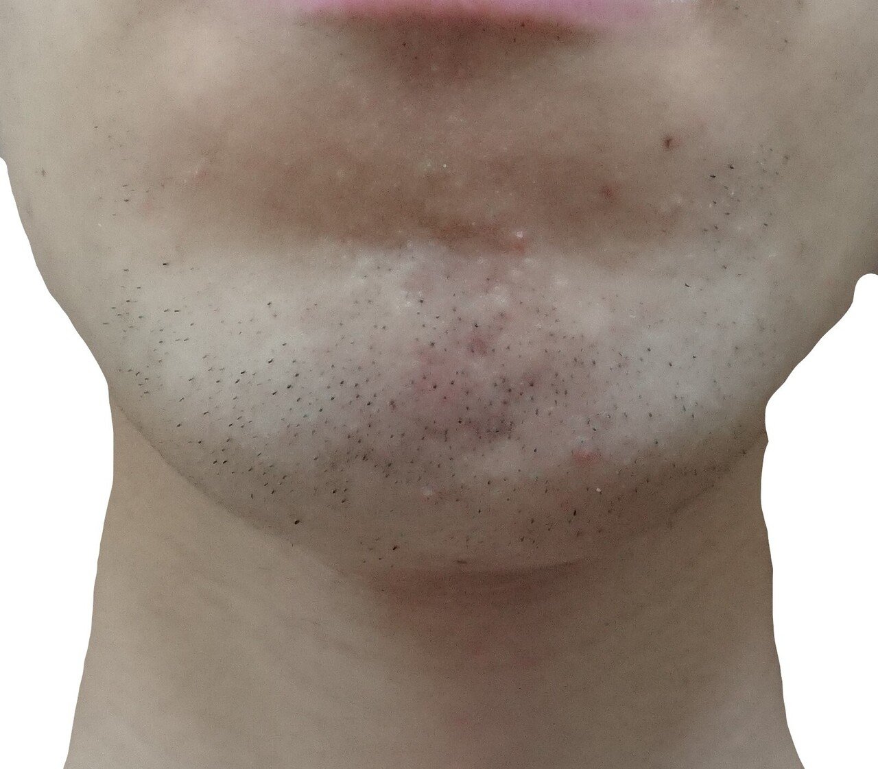 顎脱毛２回目２４時間後