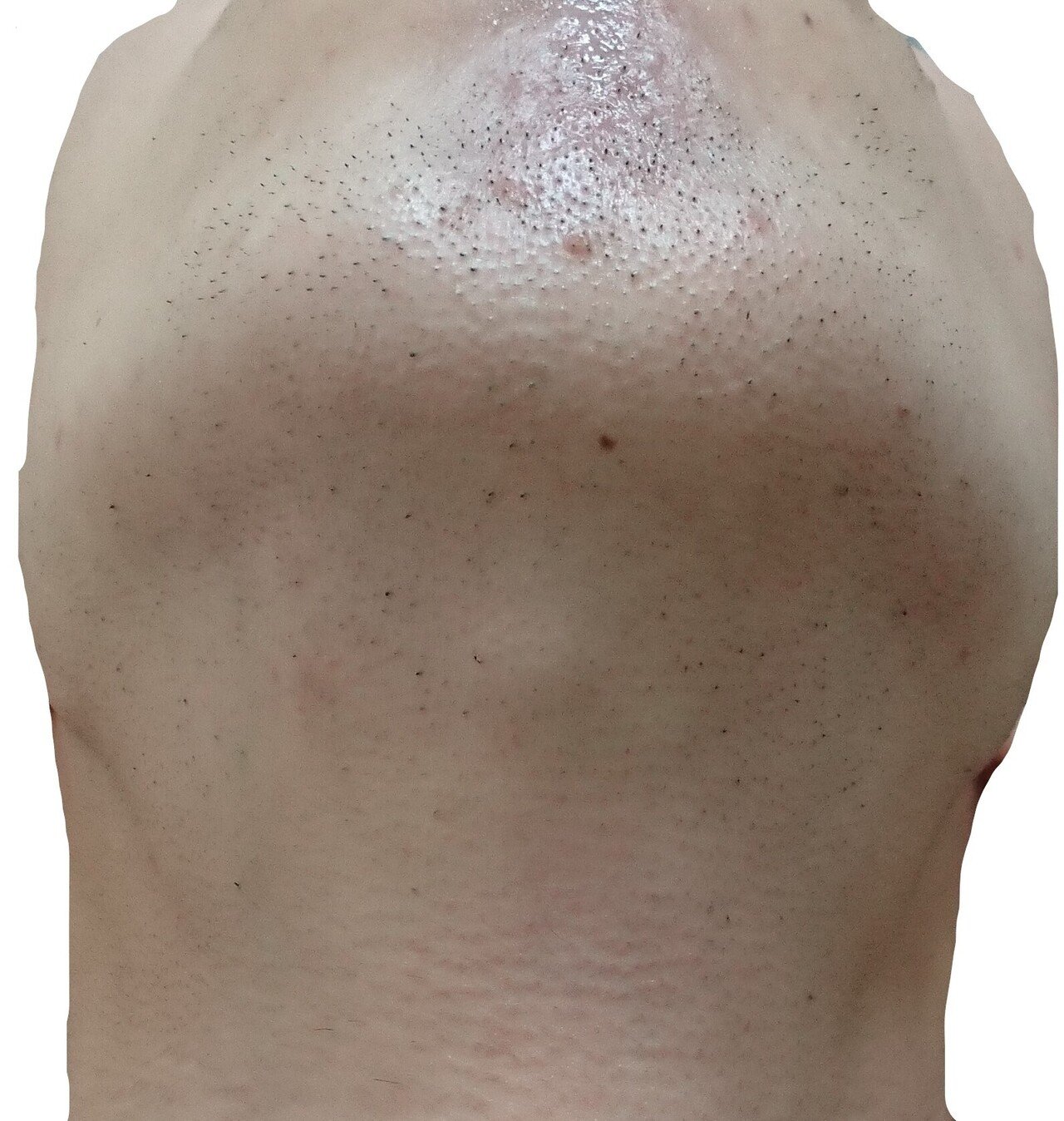 顎下脱毛２回目２４時間後